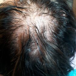 lähtötilanne naisen päälaella pigmentointi