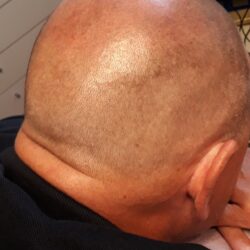 päälaki alkaa jo näyttämään tasaisemmalta. Kalju alue ei erotu enää niin selkeästi